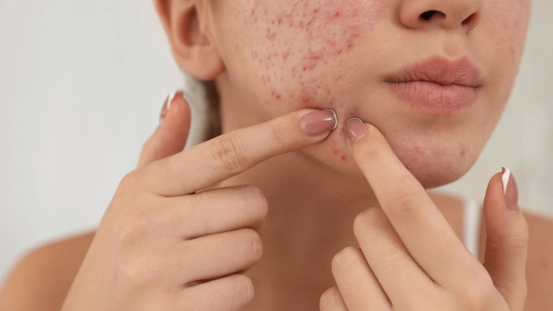 Ernährung bei hormoneller Akne: Welche Nährstoffe helfen?